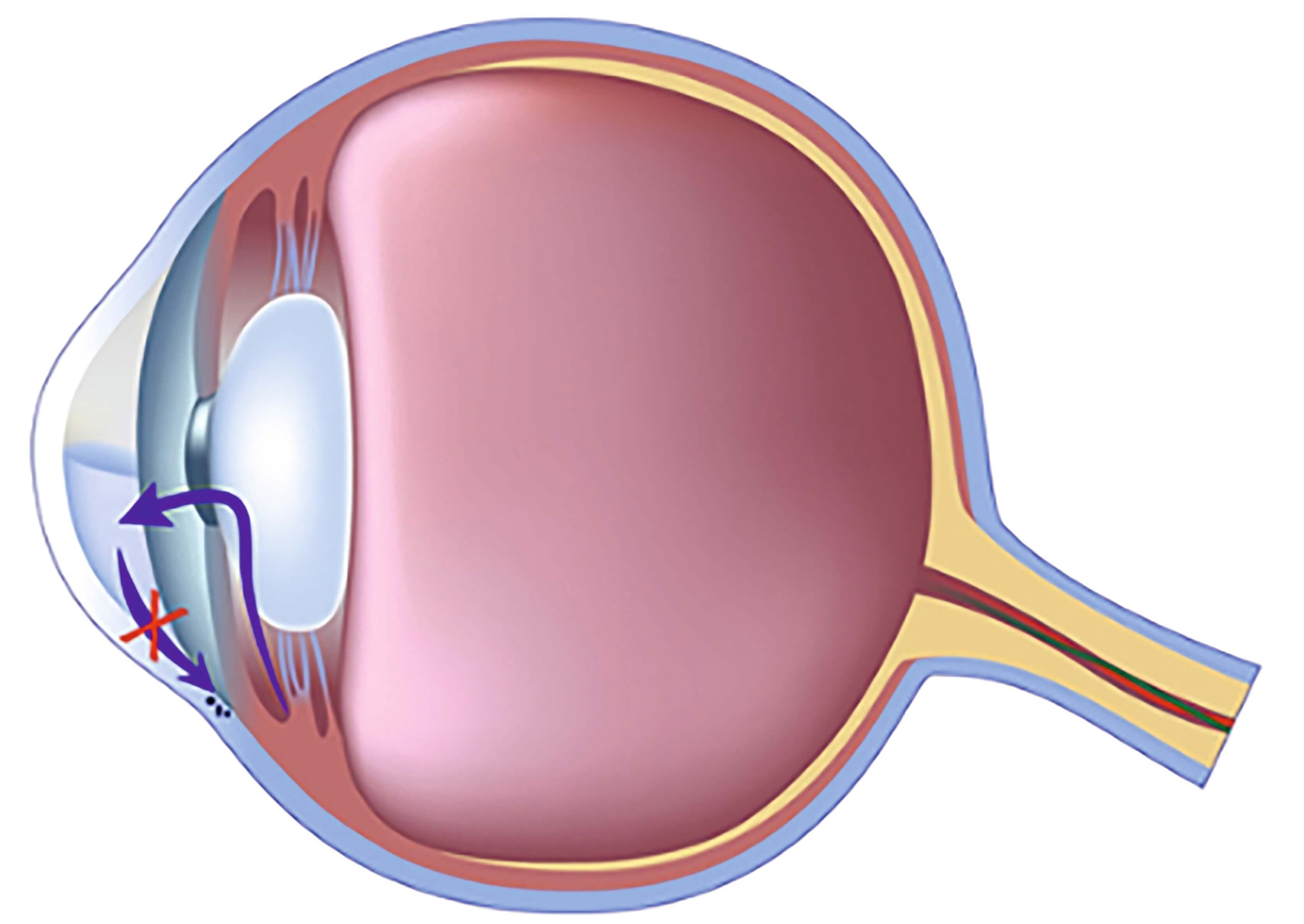 EYETECHCARE canal clogged aqueous humor builds up behind the cornea