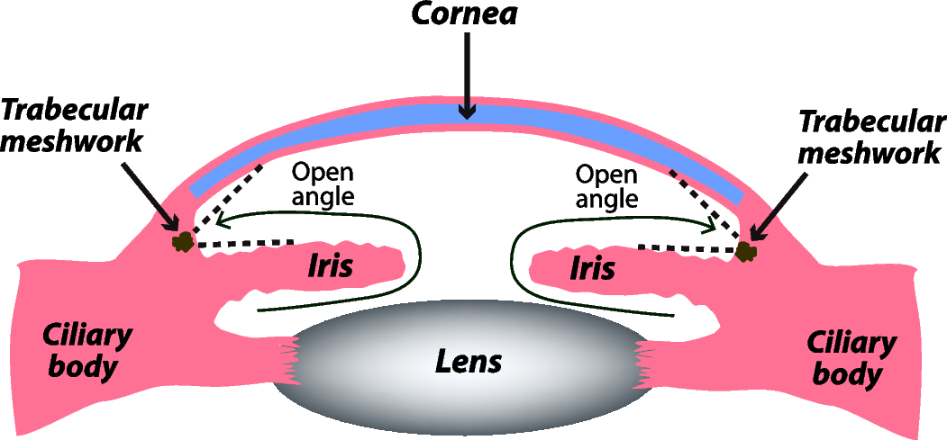 EYETECHCARE Open-angle glaucoma